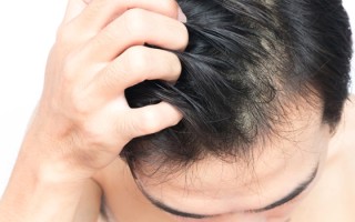 掉头发严重是什么原因女性？女性掉发原因解析