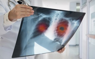 甲状腺癌如今为什么越来越常见？(高危人群早期筛查建议)